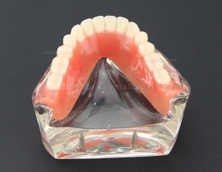 Dental Teeth Model Overdenture Inferior with 2 Implants Study Demo Model 6002 01